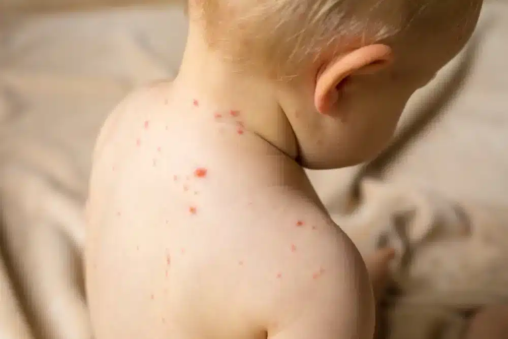 Malé dítě zezadu s viditelnými červenými vyrážkami a pupínky na bílé pokožce, což naznačuje kožní onemocnění jako jsou neštovice nebo jiná vyrážková infekce.