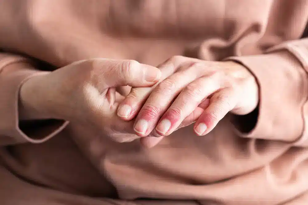 Ruce složené v klíně osoby, která má oblečen světle hnědý svetr, s viditelnými projevy suché a popraskané kůže na prstech, což jsou typické znaky atopického ekzému.